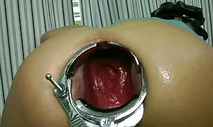 Speculum prolapse wi ...